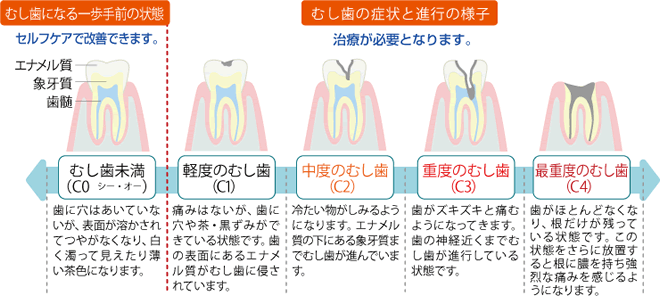 虫歯の症状と進行の様子