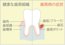 歯周病イメージ写真