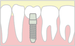 インプラントイメージ図